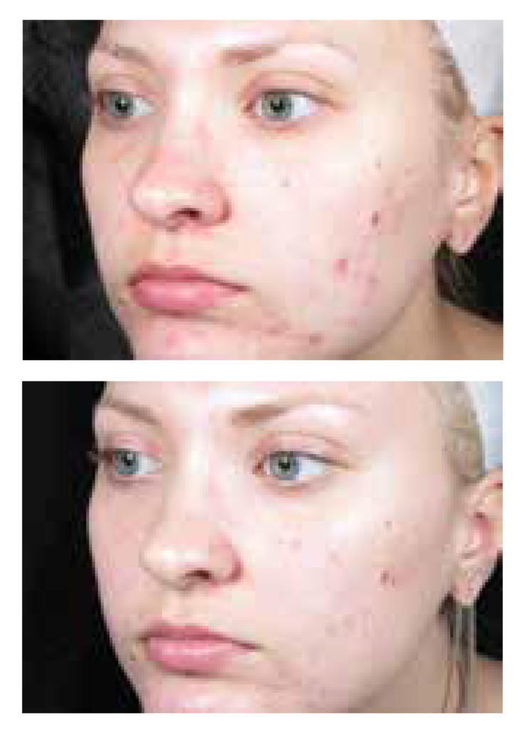 IPL Before and After